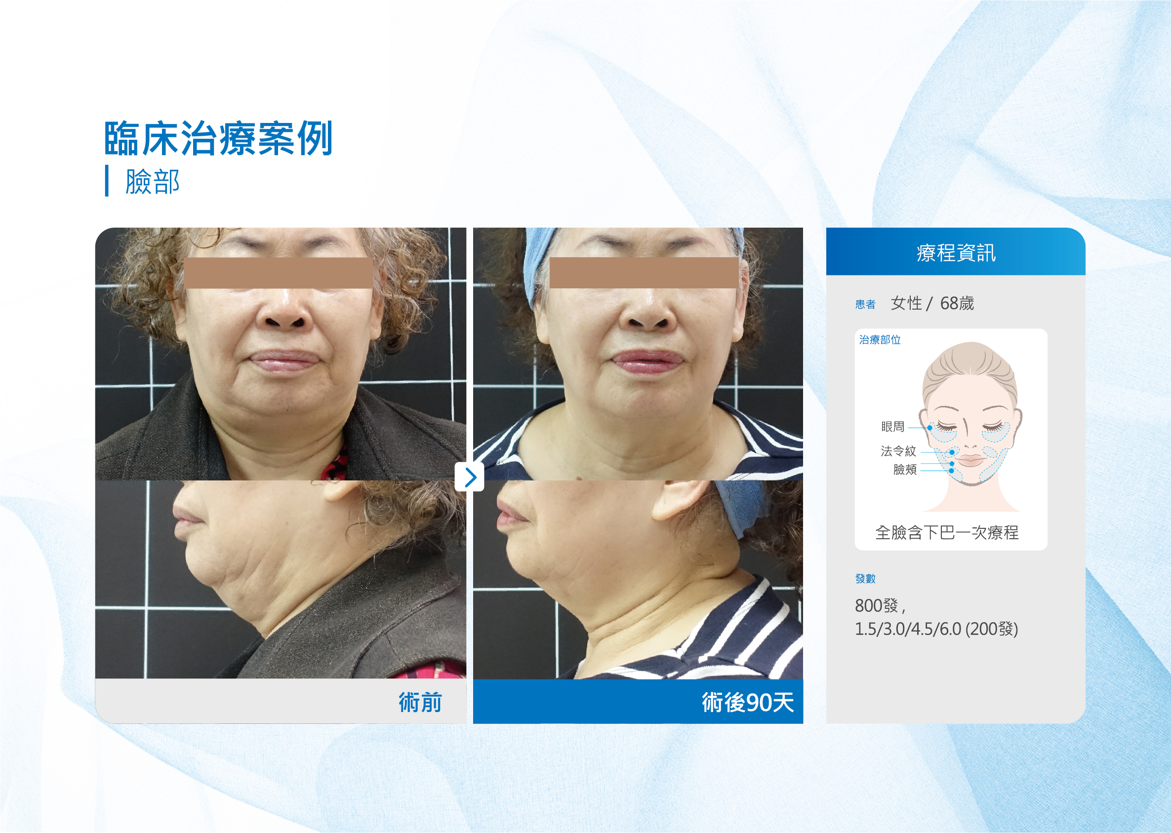 海芙音波拉提案例(臉部)女性68歲