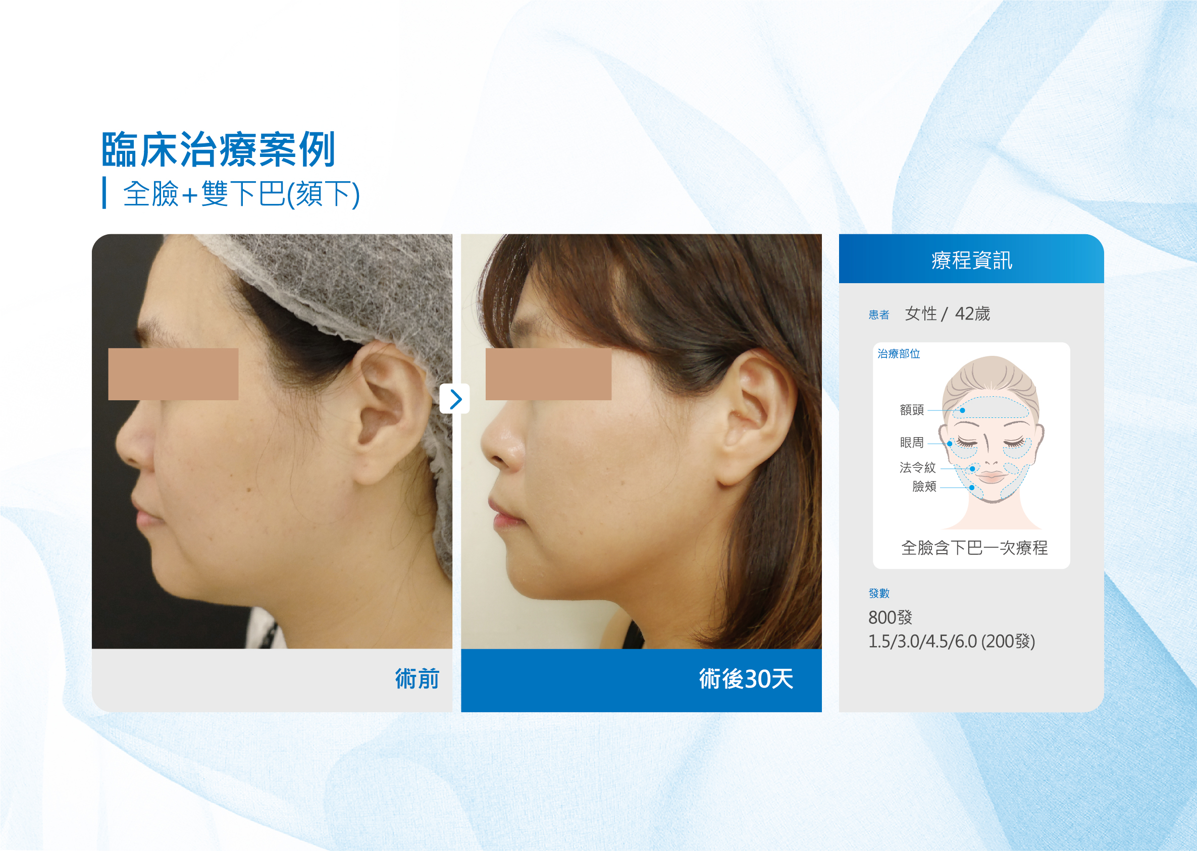 海芙音波拉提案例(全臉+雙下巴)女性42歲