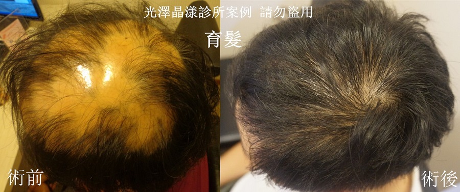 台北禿頭治療成功案件