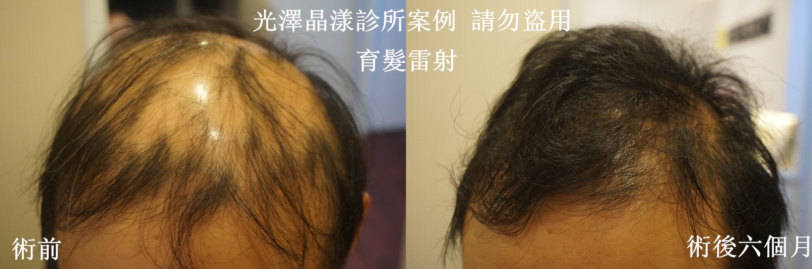 台北禿頭治療成功案例