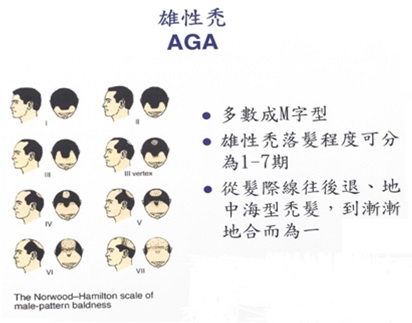雄性禿頭AGA種類